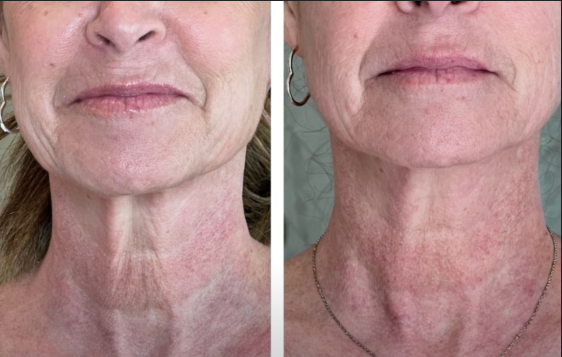Anvera™ Crepey Skin Repair Cream